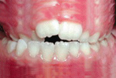 Crossbite of back teeth