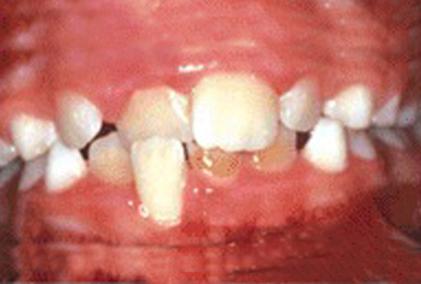 Crossbite of front teeth