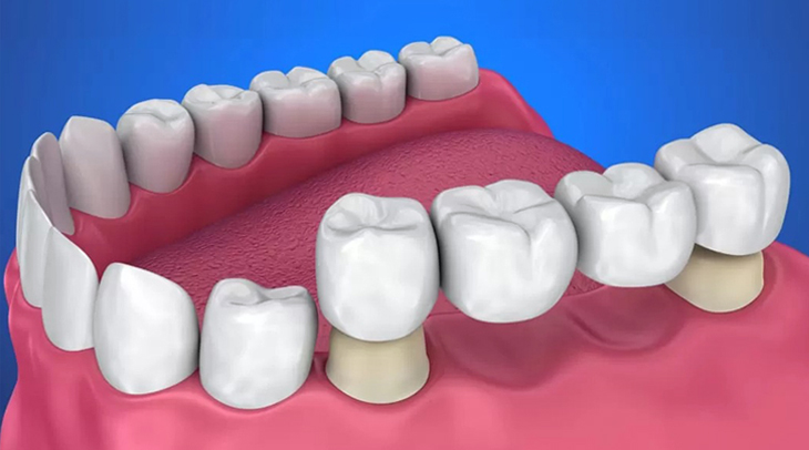 Dental bridge Colorado Springs CO