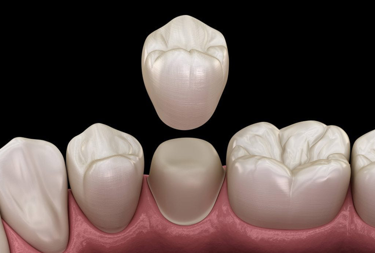 Dental Crown Colorado Springs CO