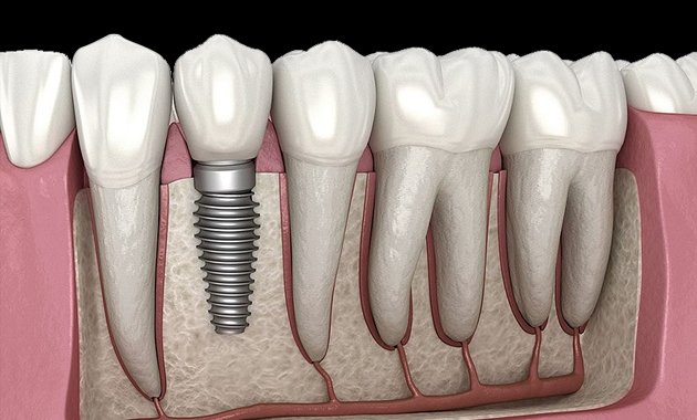 dental implants module at Apple Grove Dental office in Colorado Springs