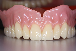 Immediate dentures