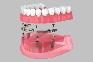Implant supported dentures