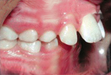 Protrusion