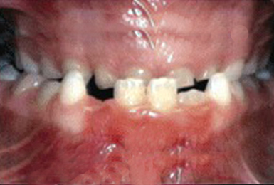 Underbite