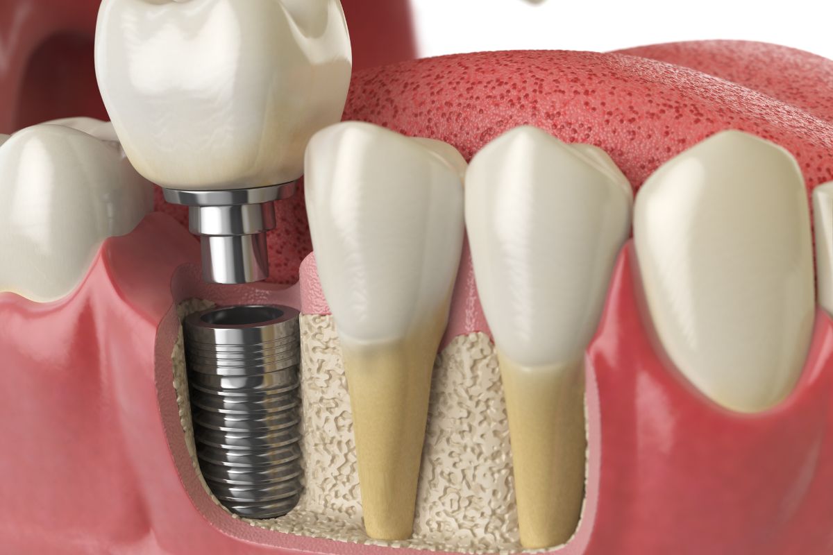 can dental implants be removed​